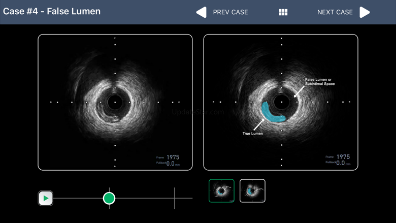 IVUS + Physiology Pro 1.0.6