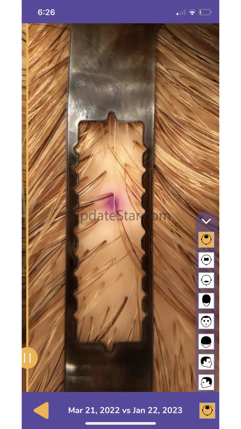 MyHairCounts 1.1.7