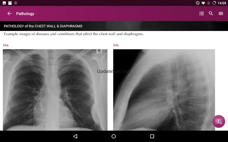 Chest X-Ray DEMO 1.3.1