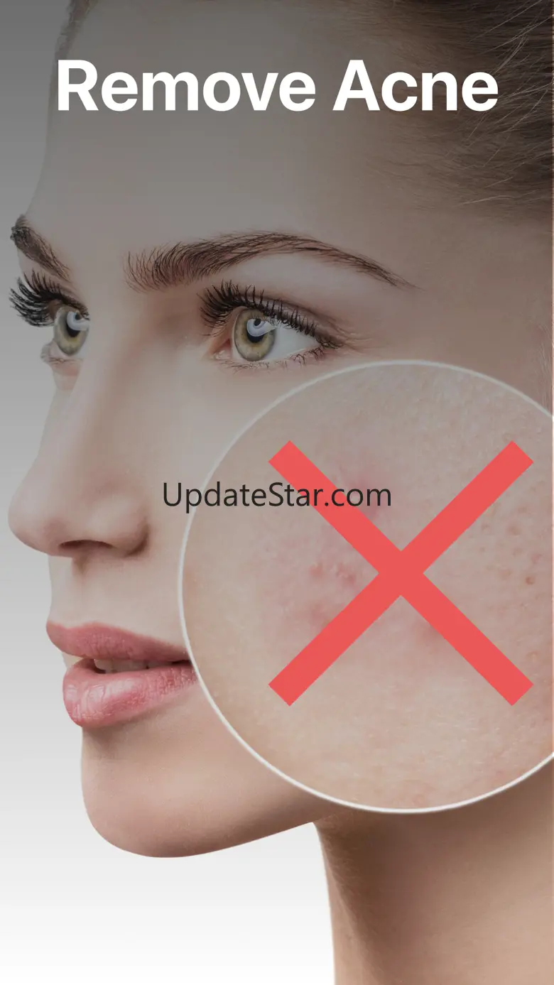 Blemish, Acne, Pimple remover 1.3