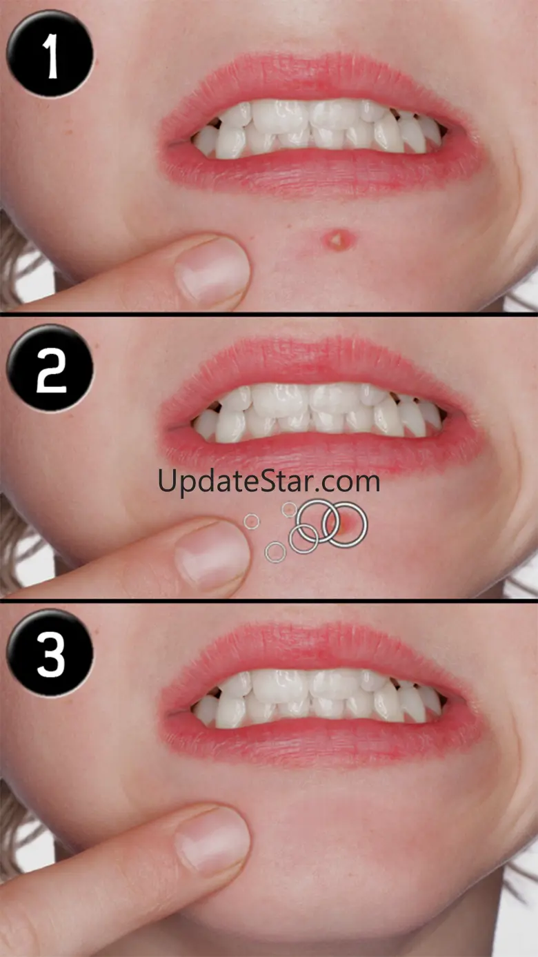 Pimple Eraser LITE 2.1