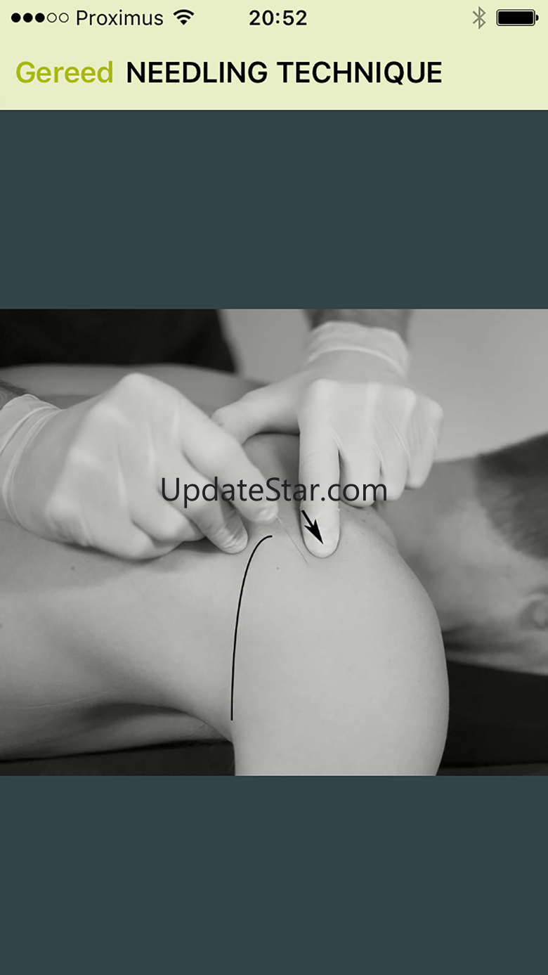 Dry Needling Guide 8.0