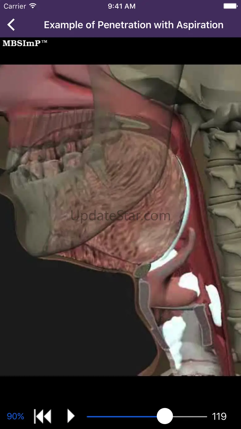 Dysphagia 2.3