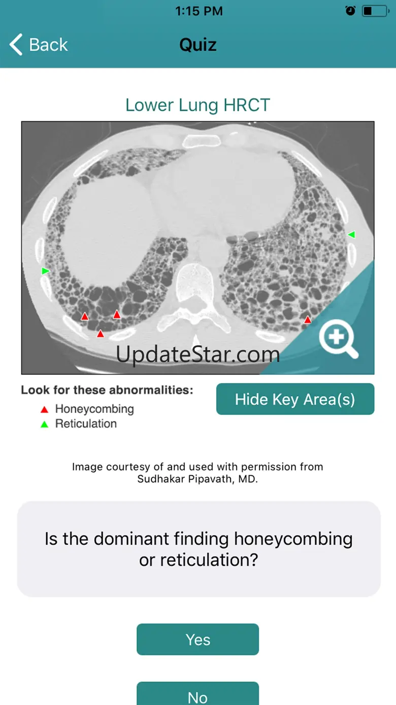 Rad Rounds UIP to IPF 2.141