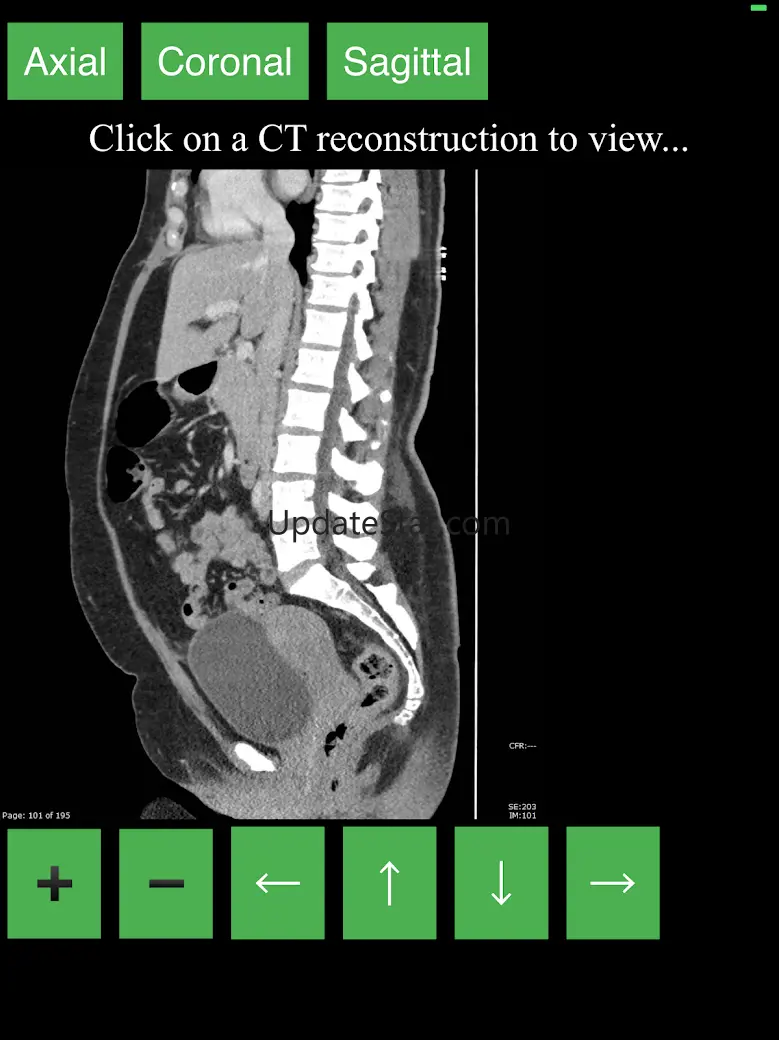 CT Abdomen Pelvis 2.0