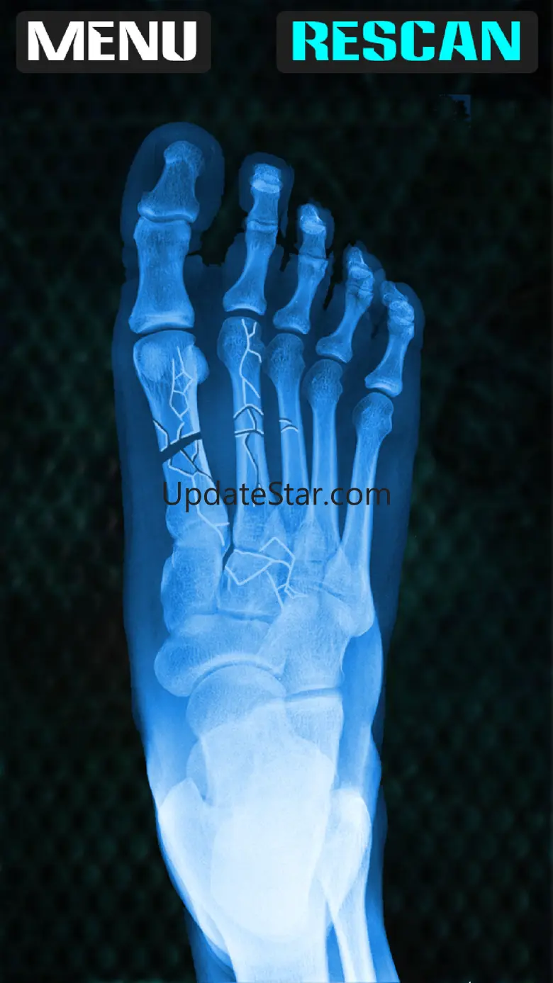 Xray Fracture Foot Prank 1.0